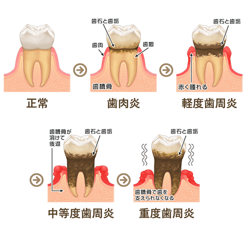 歯周病の悪化過程